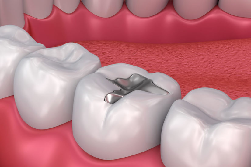 Dental Fillings paducah