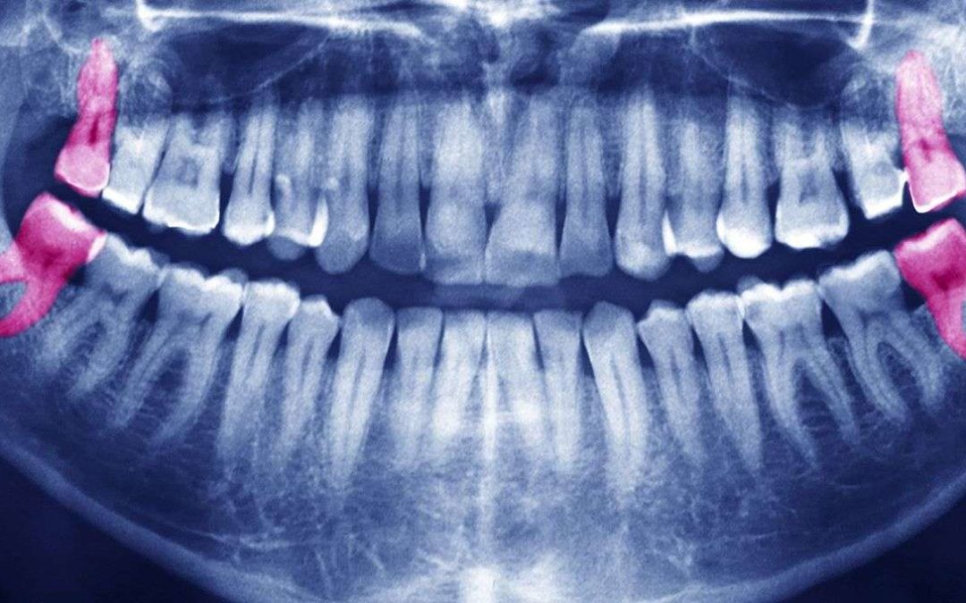 Wisdom Teeth Paducah KY