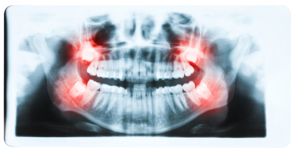 Signs & Symptoms Your Wisdom Teeth Are Coming In Paducah Dentist