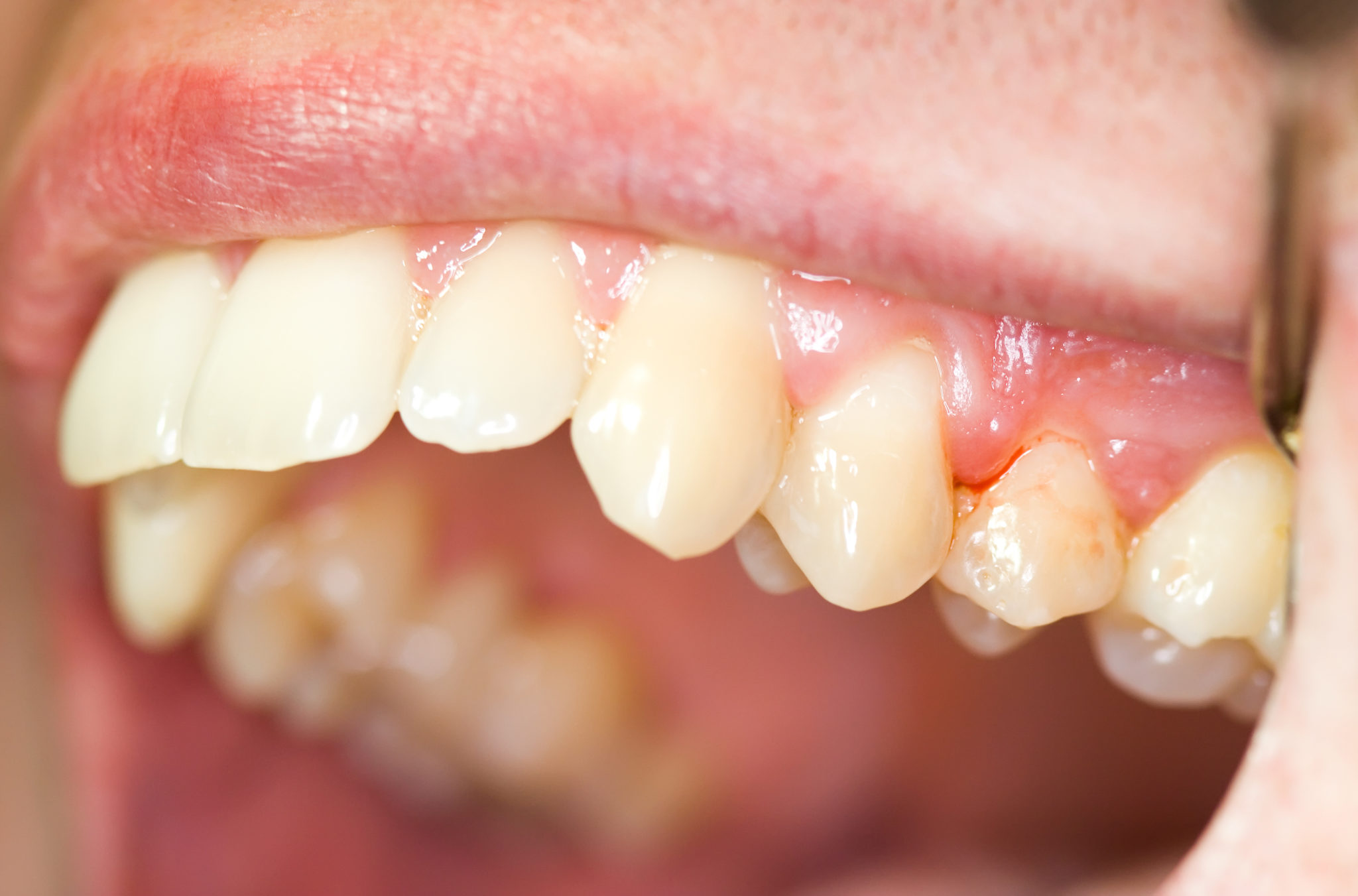 gums bleeding after dentist visit