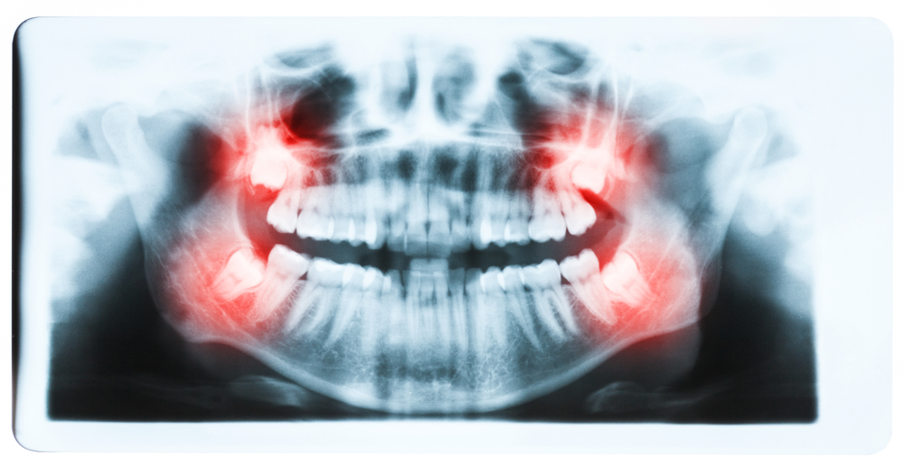Wisdom Teeth