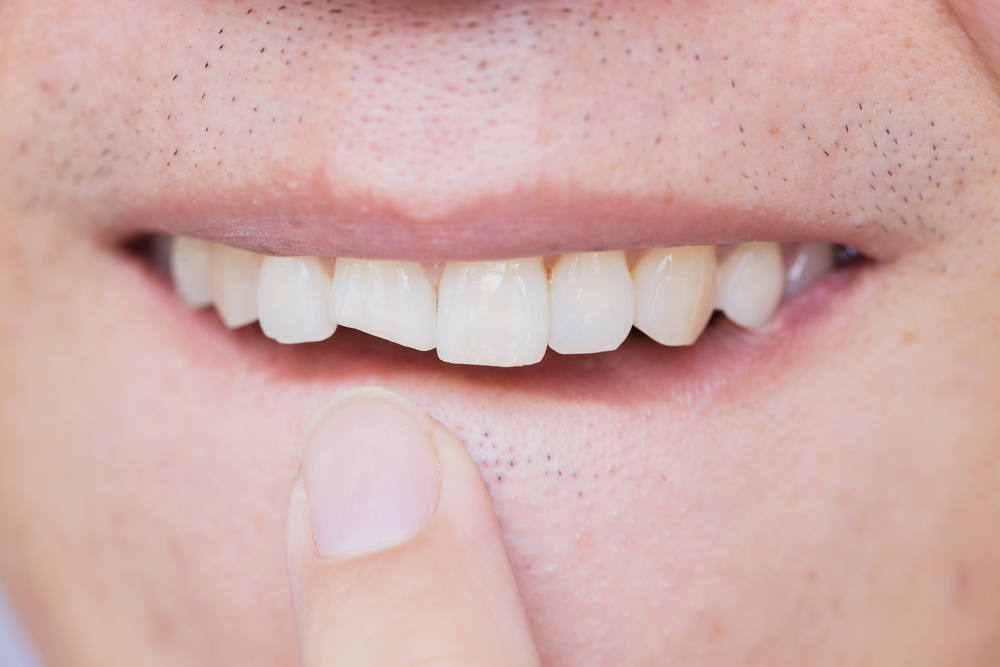 The Importance Of Repairing A Chipped Tooth
